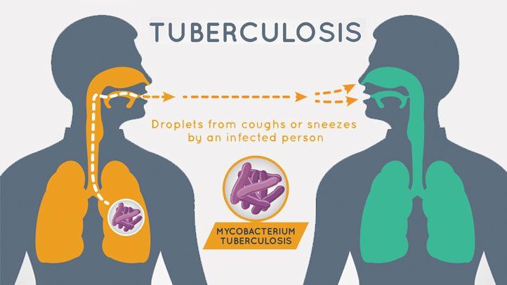 tuberculosis-risk-factors-causes-and-prevention-722x406